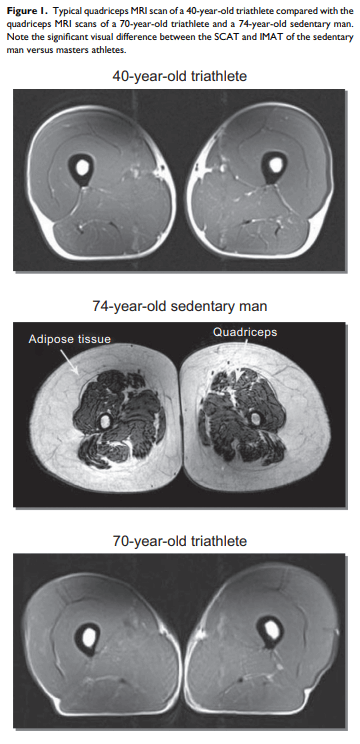 Quads on a 74-year-old sedentary man vs. a 70-year-old triathlete